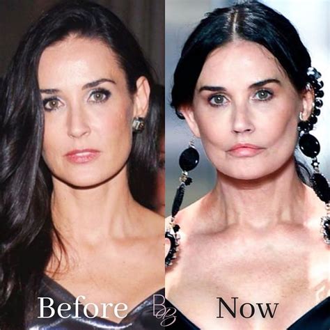 demi moore cheek fillers.